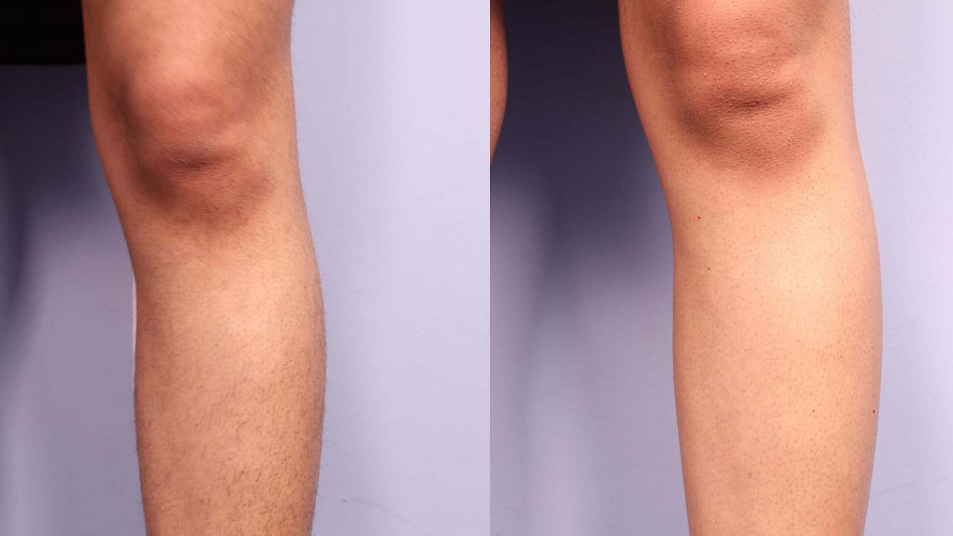 Lower Leg Before and After